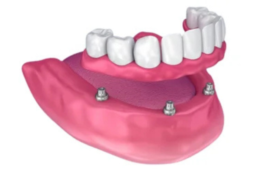 Overdentures
