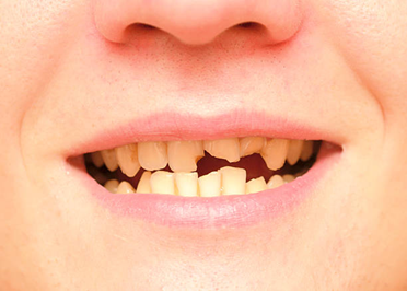 What Are Clear Aligners