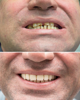 Full Mouth Rehabilitation in Andheri Clear Aligners Treatment in Andheri