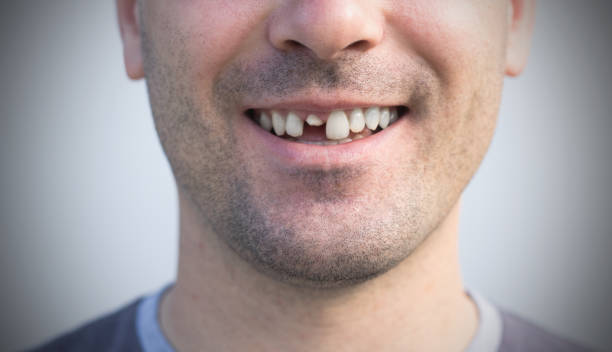 Clear Aligners Treatment in Andheri