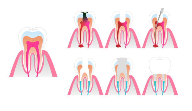 Step-by-Step Process of Clear Aligners