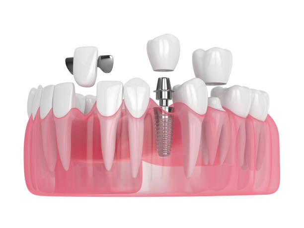 What Are Clear Aligners