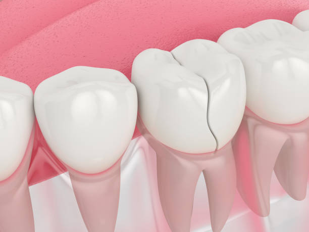 Step-by-Step Process of Clear Aligners