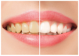 Picture2 Who Is a Good Candidate for Clear Aligners