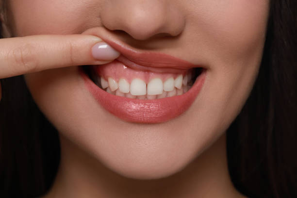 gum-contouring