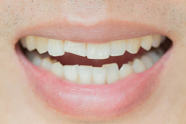chipped-teeth