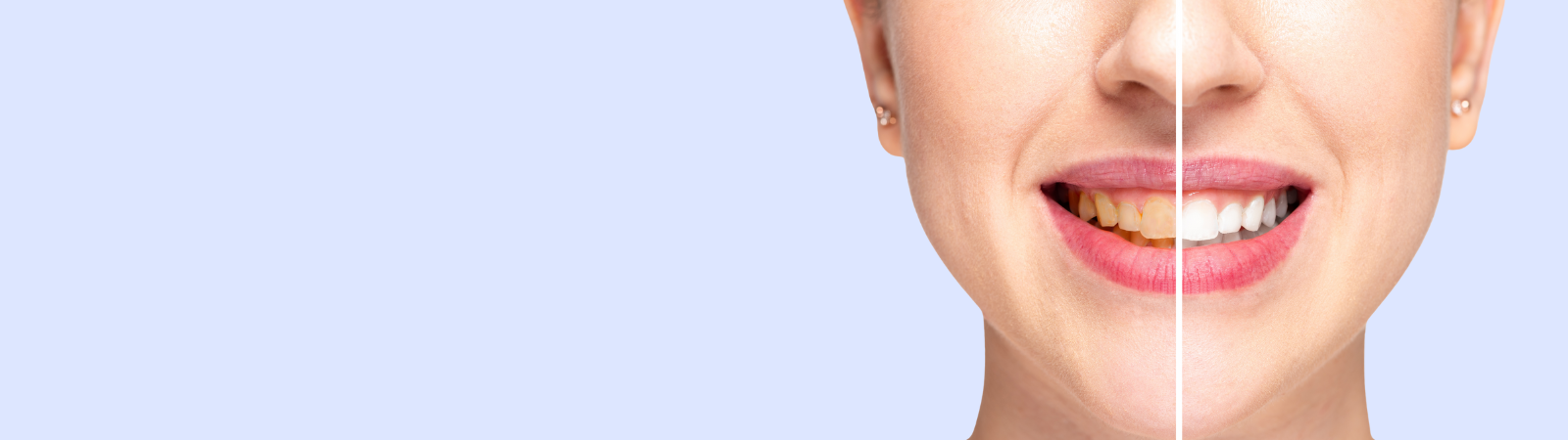 teeth-whitenig-banner teeth-whitening-banner