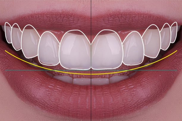 smile-design