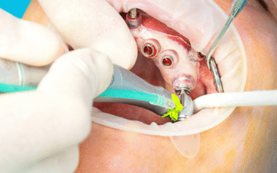 Guided Implant Surgery with Low Bone Density