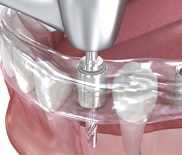 What is Guided Implant Surgery