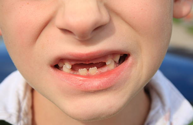 Why Dental Implants Are Considered for Children with Ectodermal Dysplasia