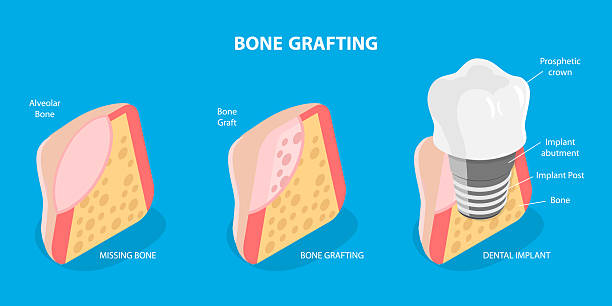 bone-grafting