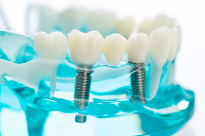 Benefits of Guided Implant Surgery
