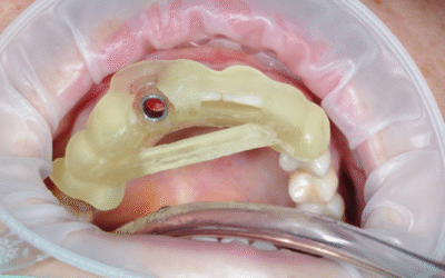 Guided Surgery in Immediate Loading Implants