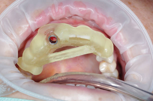 Guided Surgery in Immediate Loading Implants