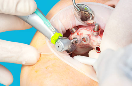 What is Guided Implant Surgery