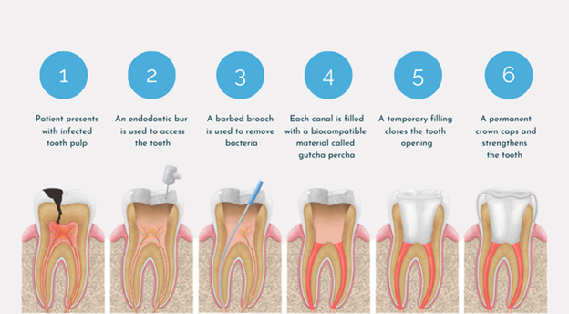 Types of Implants Used in Guided Surgery for Immediate Loading